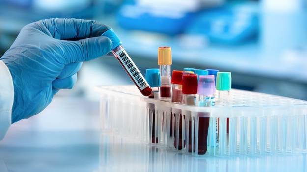 Blood sample tubes ready for testing